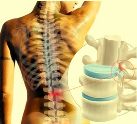 Que síntomas cuando a ti la osteocondrosis