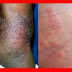 Obat Tradisional Alami Herpes Zoster thumbnail