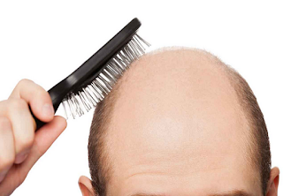 Prevent hair loss with these helpful tips Prevent hair loss with these helpful tips