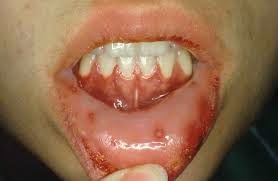 Penyakit Cacar Atau Herpes Di Mulut