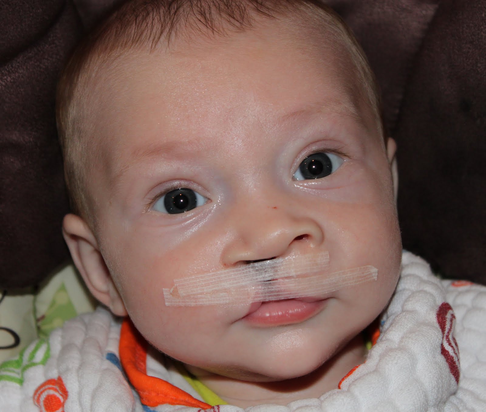 Step by Step Cleft Taping and Ear tubes