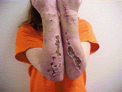 Meth+Bugs+Under+Skin ... , known as “ Meth Mites or Bugs ,” moving right under their skin