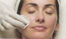 chemical peel
