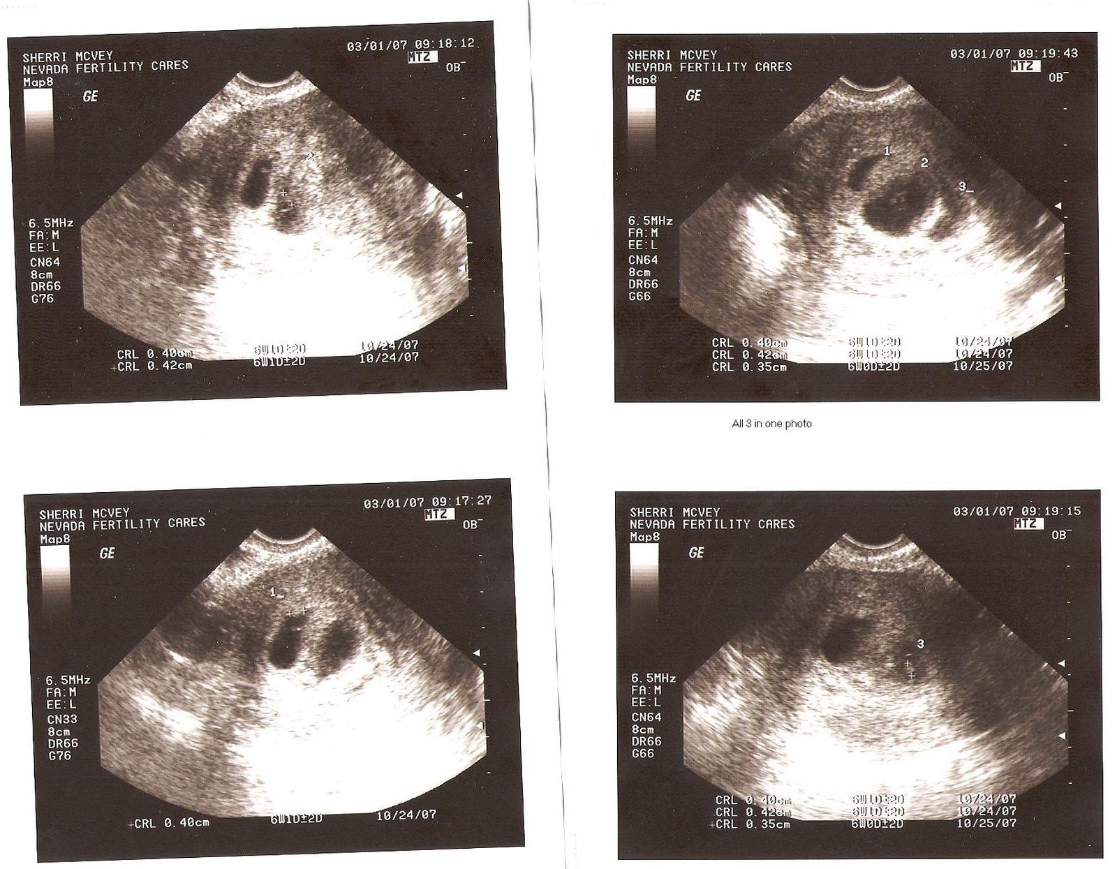 [Ultrasound+of+the+3+sprouts+-+3-2-07.JPG]
