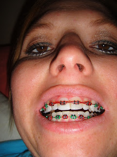 braces getting month teeth bad bottom pink
