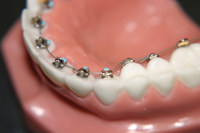 Lip Piercing Braces