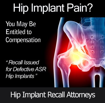 Johnson Johnson Hip Replacements De Puy | ASR DePuy Hip Implant Lawsuits | Recall