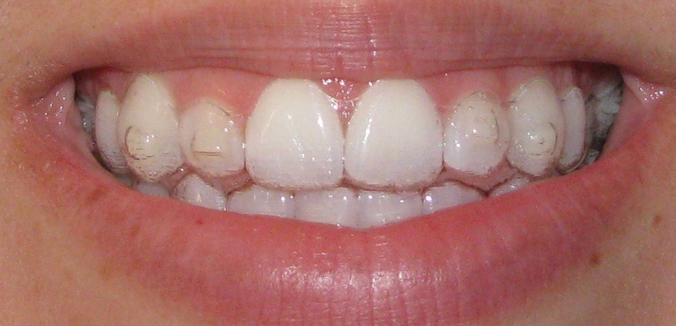 invisalign attachments