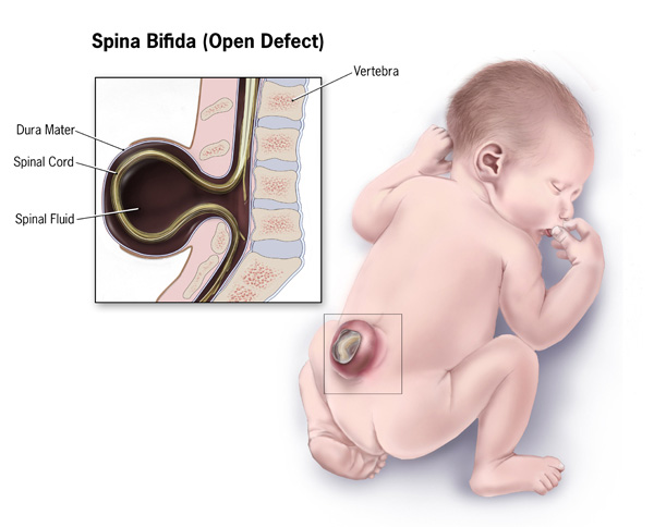 [espina+bifida.jpg]