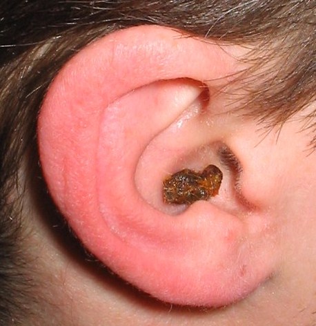 worst ear wax