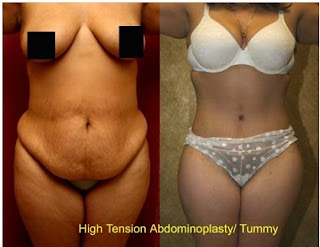 Los Angeles Tummy Tuck