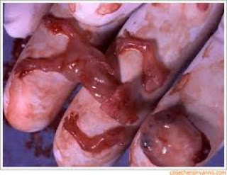 INFORMACION DEL ABORTO informacion del aborto: