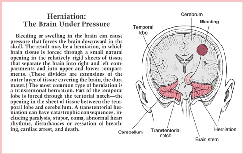 brain herniation