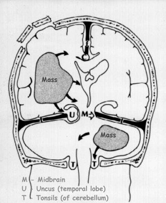 brain herniation