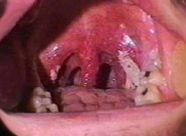 enfermedades respiratorias: Faringitis cronica