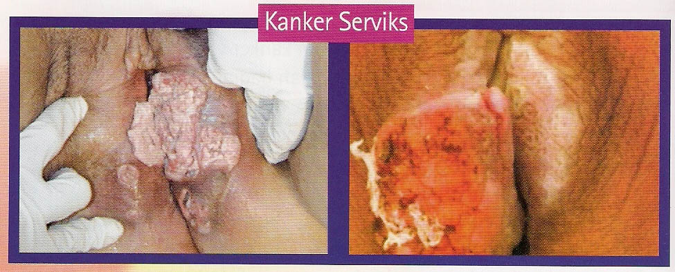 Kanker Mulut Rahim