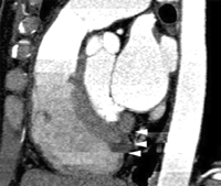 helical ct artifacts
