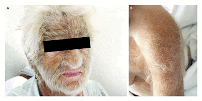 Anorexia Lanugo Pictures