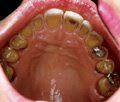 bulimia-teeth