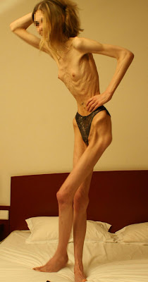 anorexic, young girl, anorexia, starvation