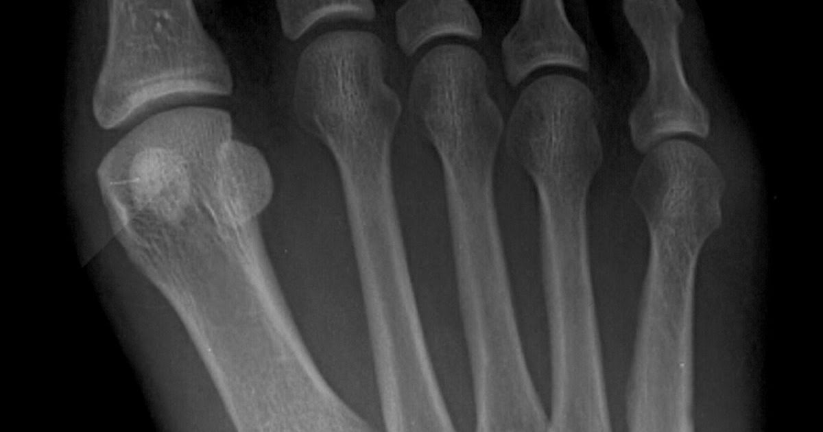 Hairline Fracture Foot Fracture Treatment