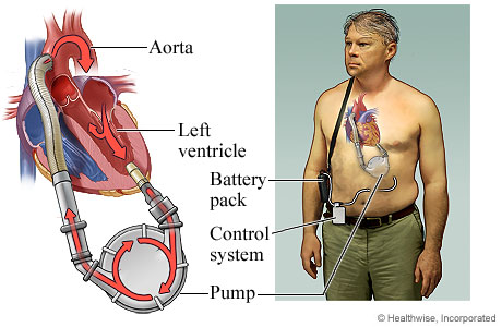 Lvad Driveline