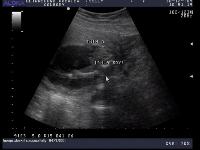 My Grand LIfe: It's a BOY and a GIRL - 17 Week Ultrasound