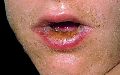 Lip Rash