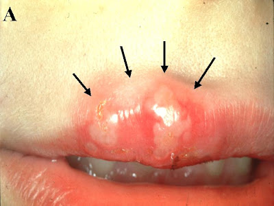 genital herpes mouth. herpes sores on tongue. genital herpes mouth.