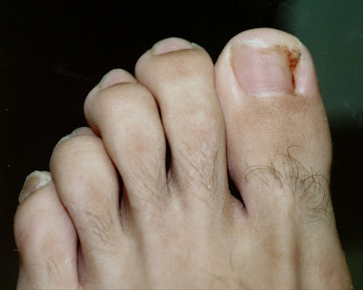 Pictures of ingrown toenails.