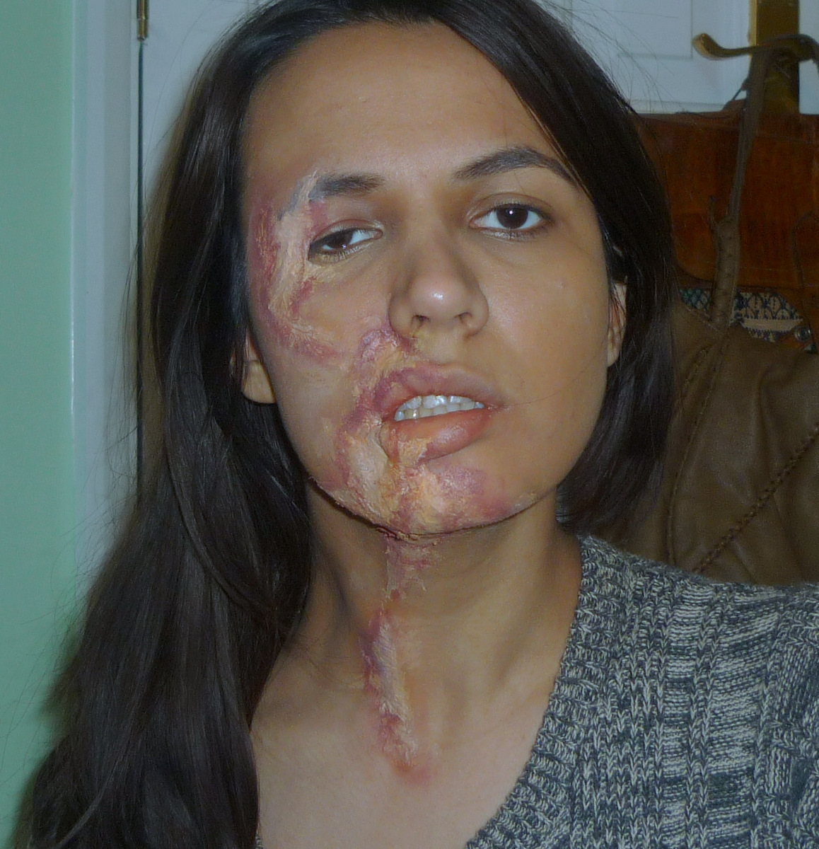 Acid Burn Skin
