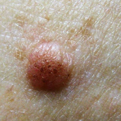 Girl next asymmetrical facial mole cancerous