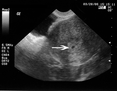 images of 5 weeks pregnant. January 28th 5 weeks 3 Days