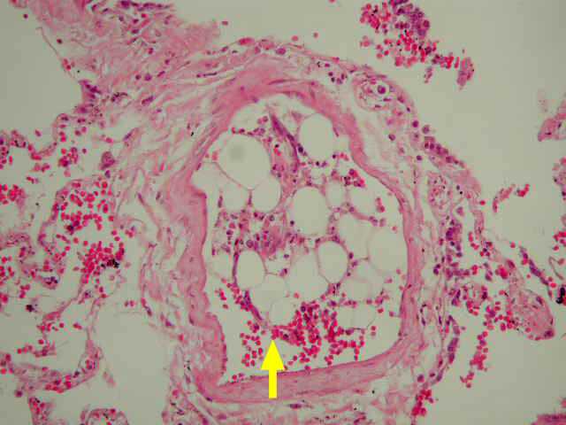 What S Up Today Fat Embolism