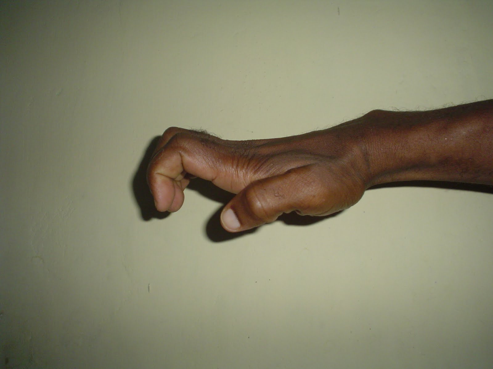 Claw Hand Deformity