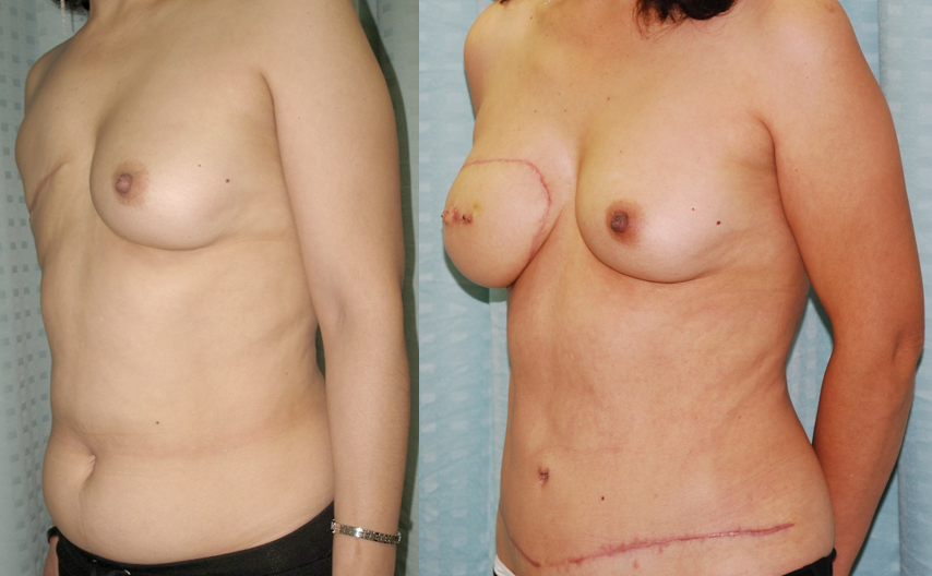 Second Stage Breast Reconstruction Nipple Areola Complex Reconstruction