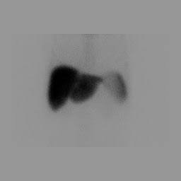 Figure 1: Normal sulfur colloid biodistribution shows radiotracer predominantly within the liver. Figure 1: Normal sulfur colloid biodistribution shows radiotracer predominantly within the liver.
