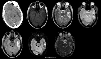 Hemorrhage On Mri