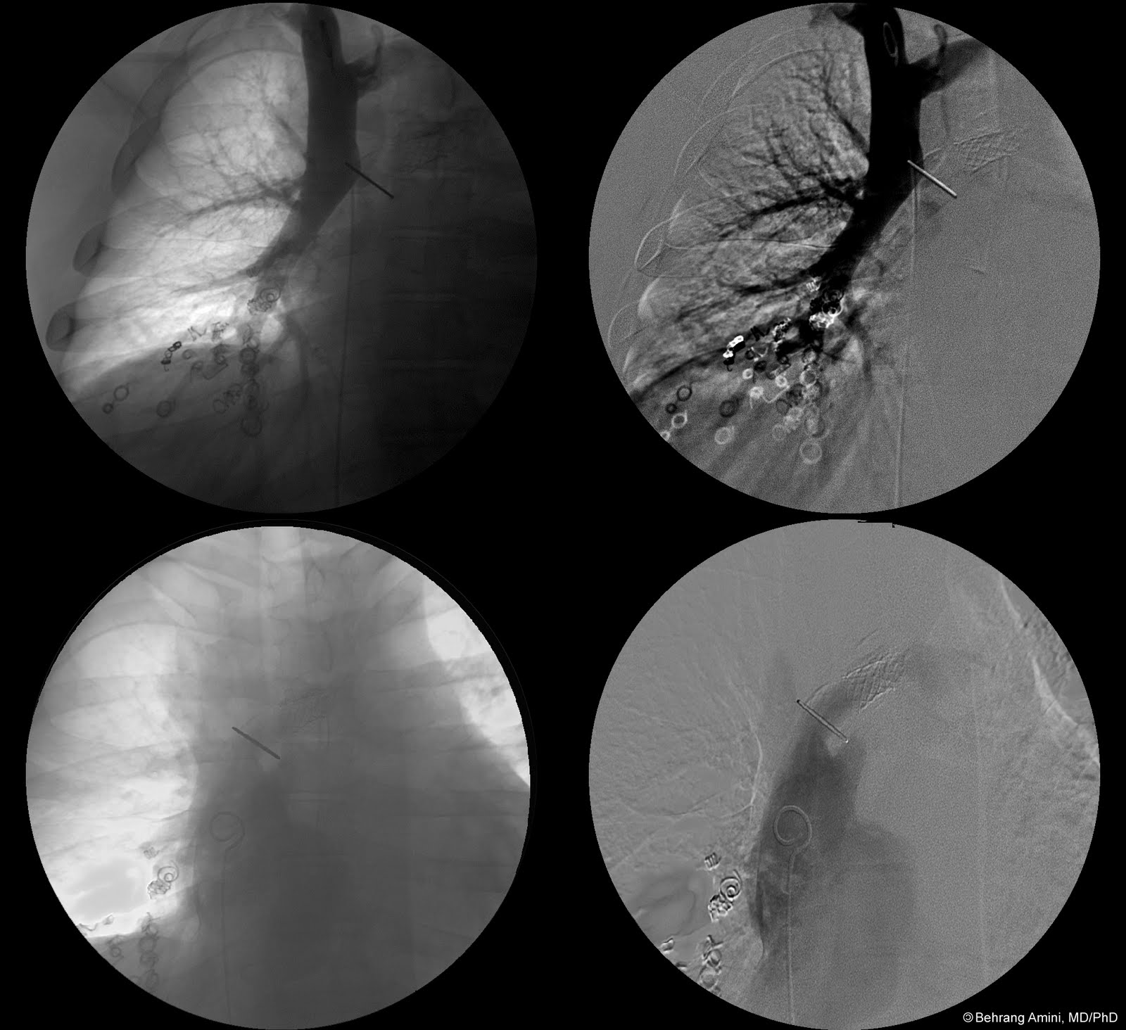Bidirectional Glenn Anastomosis