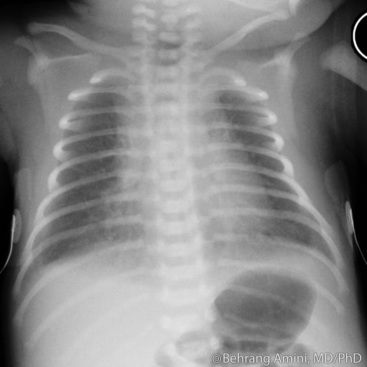 Fractured Clavicle-4.bp.blogspot.com Fetal Lung