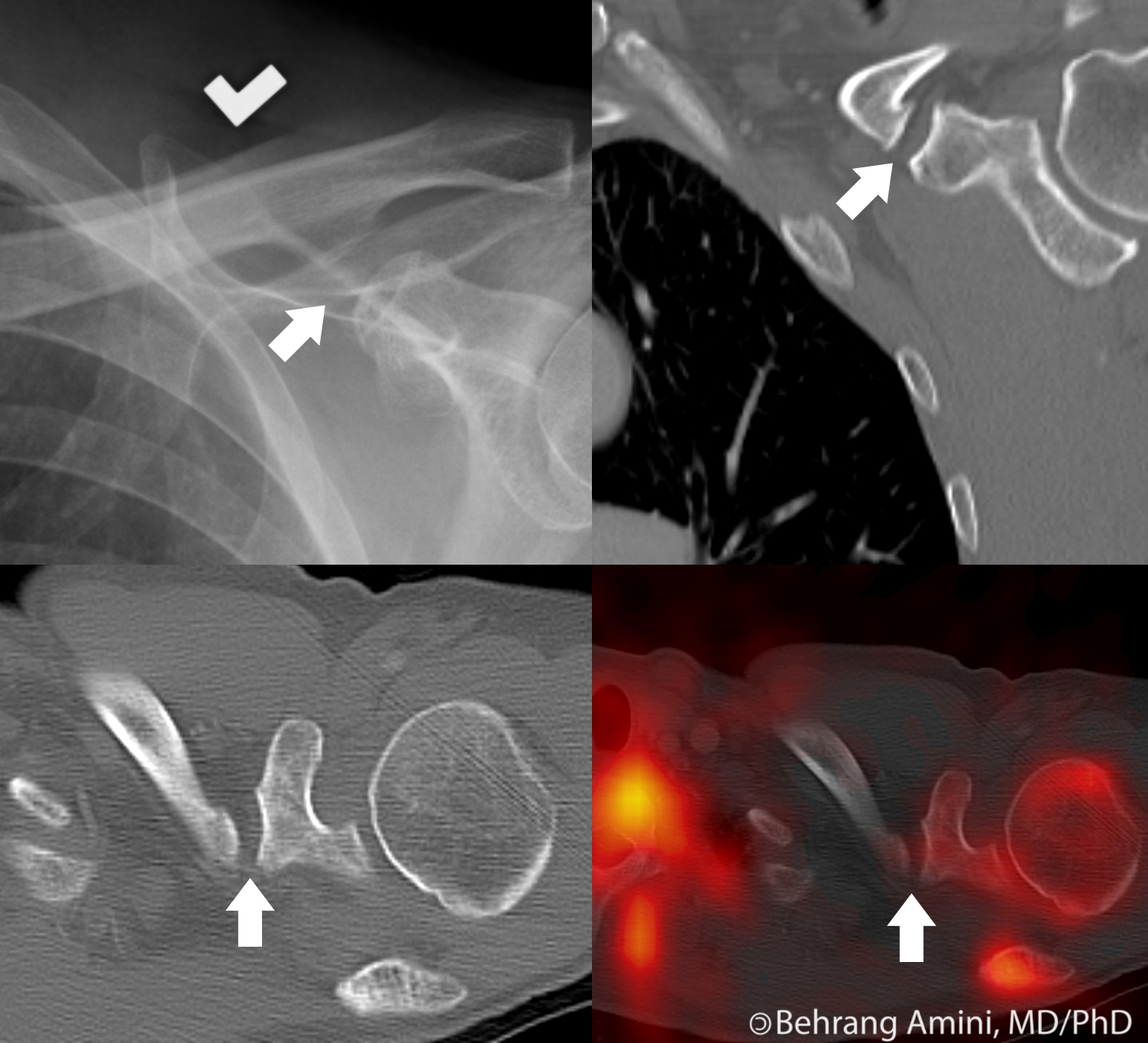 Conoid Tubercle