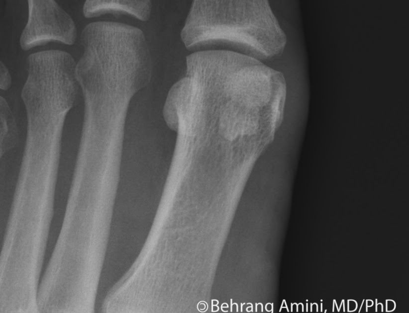 Roentgen Ray Reader: Bipartite Sesamoid vs Fractured Sesamoid