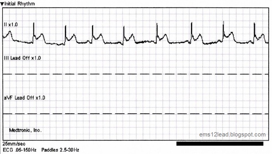 The Missed Stemi Ems 12 Lead