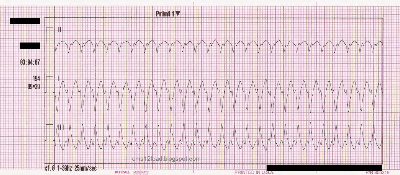 transcutaneous pacing pads