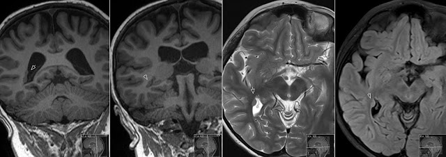 Heterotopic Gray Matter