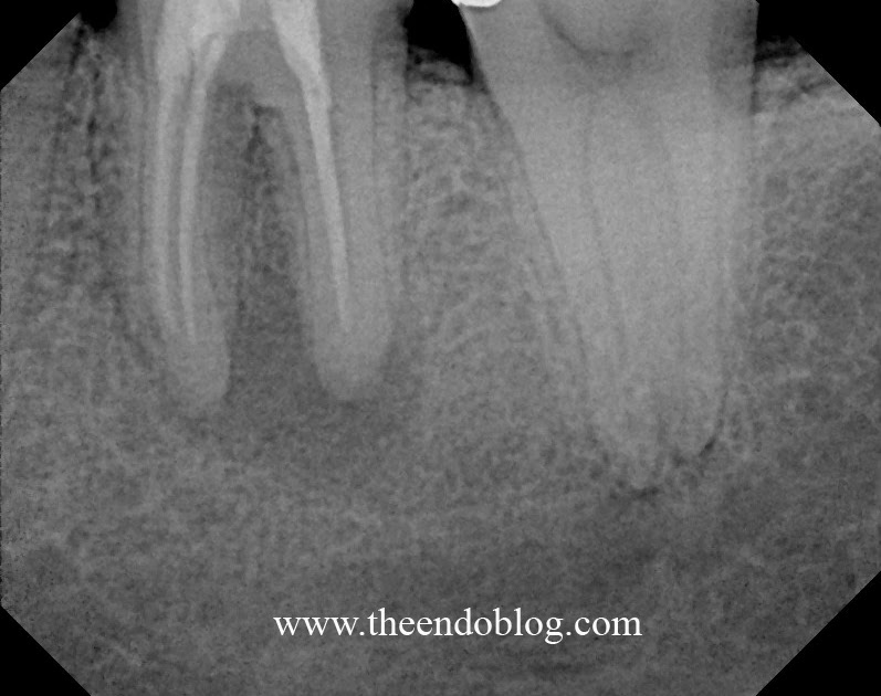 The Endo Blog Calcium Hydroxide as Intercanal Medicament