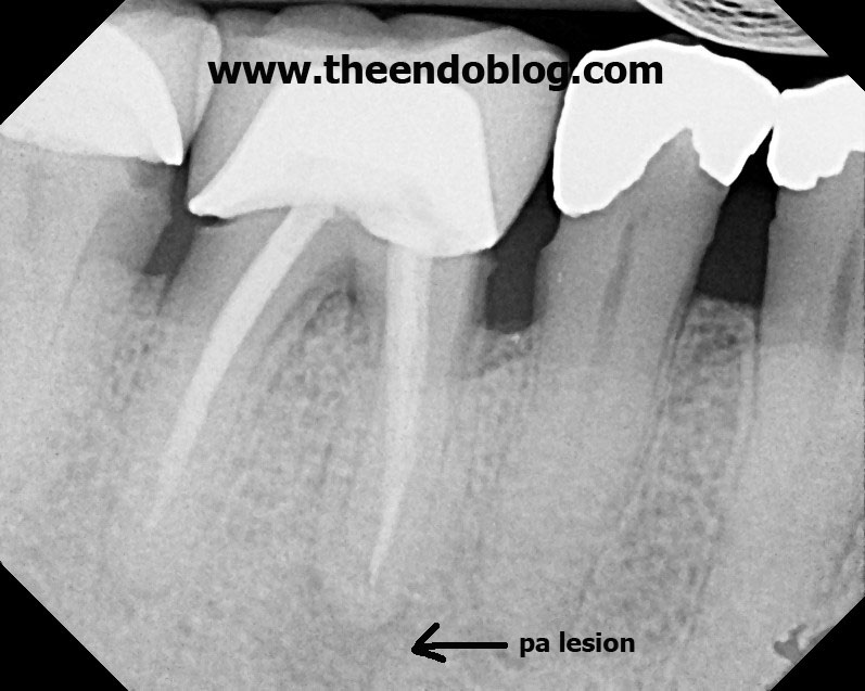The Endo Blog The Blame Game Root Canal Failure?