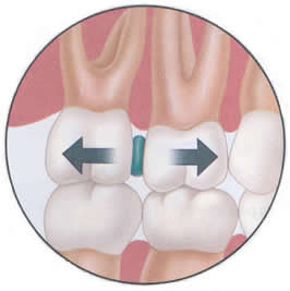 Mouth Spacers