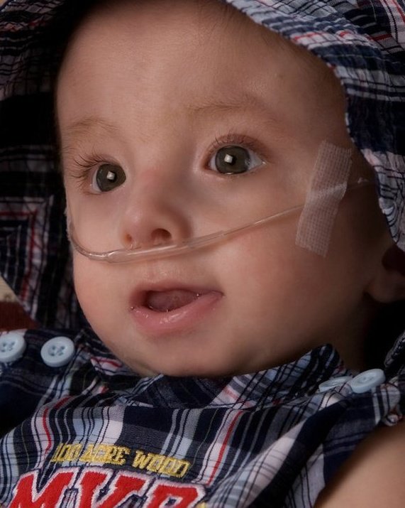 caleb Trisomy What Is The Disease Affecting Rick Santorum s Daughter