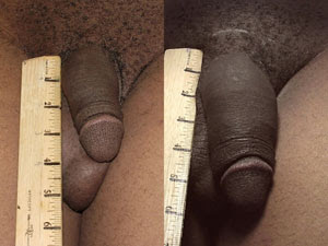 Whether it is possible to increase the penis in men
